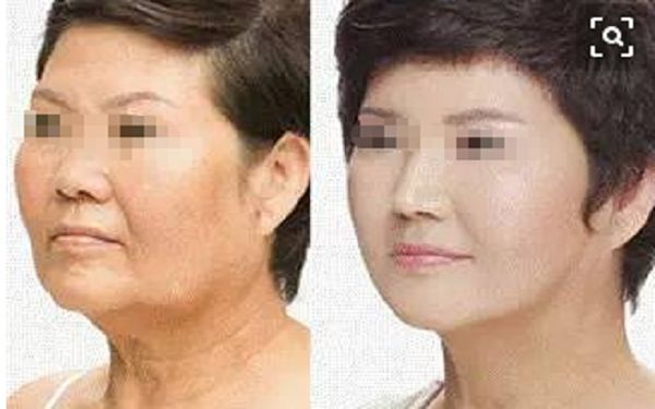 膨體隆鼻：揭秘改善鼻型的高效方法