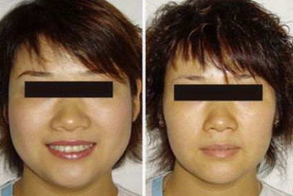 隆鼻手術(shù)后的常見問題有哪些