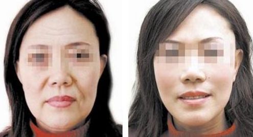 雞蛋殼內(nèi)膜祛黑頭有效嗎？黑頭成因及改善方法揭秘！