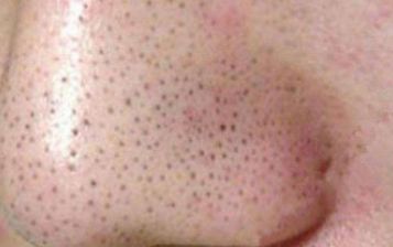 雙眼皮手術(shù)失敗后的補(bǔ)救措施及經(jīng)驗(yàn)分享