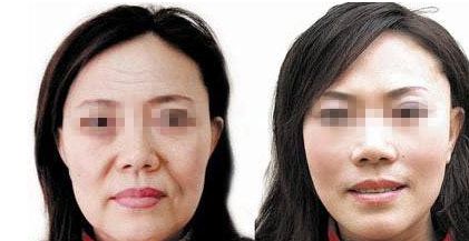 下頜整形常見(jiàn)技術(shù)及優(yōu)缺點(diǎn)解析