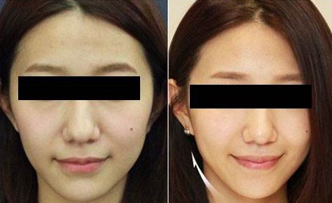 鼻綜合整形的五大效果影響因素