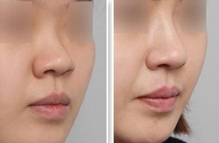 隆鼻修復(fù)手術(shù)：讓你的容顏煥然一新