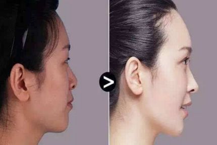 雙眼皮手術(shù)效果如何？割出雙眼皮有什么關(guān)鍵？