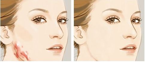 腹部吸脂：揭秘五大盲區(qū)，告別脂肪困擾