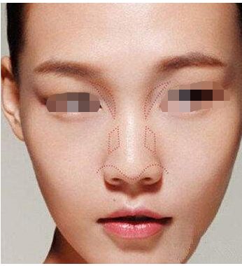 腹部抽脂術(shù)前需要注意什么