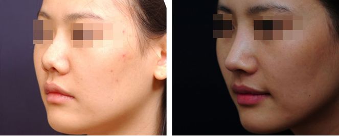 尹林麗格咬肌肥大如何改善，放大問題果真靠譜嗎？