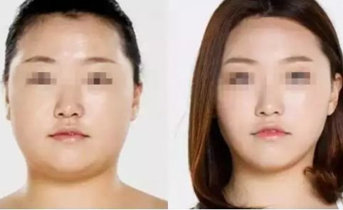 如何瘦腿？吸脂還是塑形？方法對(duì)比與價(jià)格解析