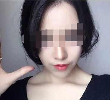 穆雄錚顴骨整形手術(shù)解析，修復(fù)顴弓美麗重生！顴骨整形術(shù)后恢復(fù)時(shí)間淺析