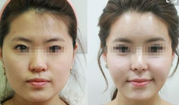 去除眼袋皺紋的五種方法，讓你恢復(fù)年輕青春的秘密！