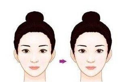 蘇州隆鼻手術(shù)費(fèi)用及效果如何？