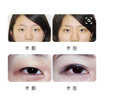 恢復(fù)處女膜：經(jīng)驗分享與修復(fù)方法