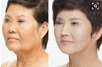 15歲女孩整容成果驚人！爸媽都認不出來了