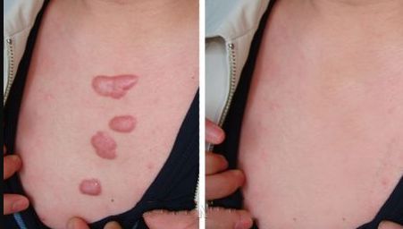 光子嫩膚紅血絲好效果，有效緩解面部紅血絲問題