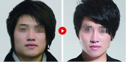 隆鼻修復(fù)，如何科學(xué)達(dá)到理想效果？