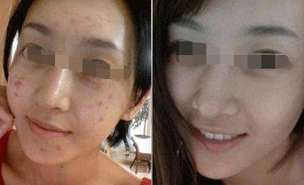 腿部吸脂術(shù)后出現(xiàn)腳腫現(xiàn)象，如何緩解？