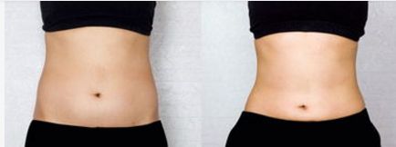 時(shí)尚達(dá)人必選！令人年輕的電波拉皮術(shù)，輕松消除皺紋