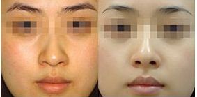 隆鼻術(shù)前須知，鼻炎患者可進行手術(shù)嗎？