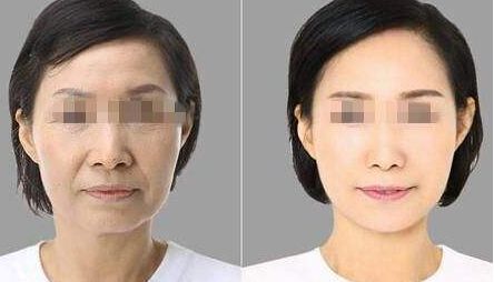 消除眼袋黑眼圈的實(shí)用方法及注射透明質(zhì)酸恢復(fù)時(shí)間