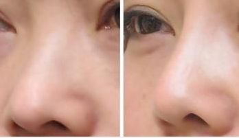 湖南雙眼皮修復(fù)，成功率備受矚目