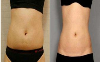 鼻部整形手術(shù)麻醉方式是局部還是全身？