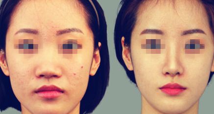 打造精致臉龐 這種法術(shù)你值得擁有！探討瘦臉注射去皺費(fèi)用