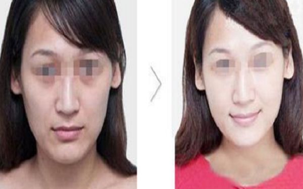 耳廓再造術(shù)后洗澡安全細(xì)解