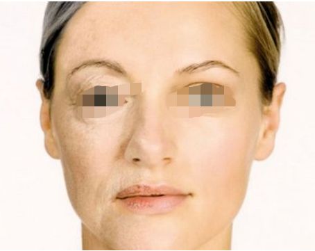 全耳重塑手術(shù)的成功率及時(shí)程揭秘