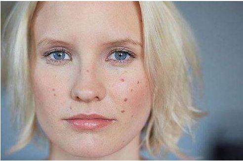 光子嫩膚如何收縮毛孔？原理及注意事項(xiàng)大揭秘！