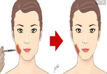 隆鼻手術(shù)：比較假體隆鼻與膨體隆鼻，哪種更適合你？