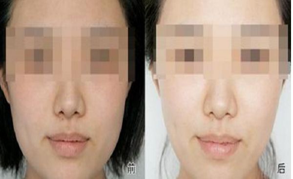 修復(fù)雙眼皮失敗的方法與效果，全面解析助你成功擁有完美雙眼皮