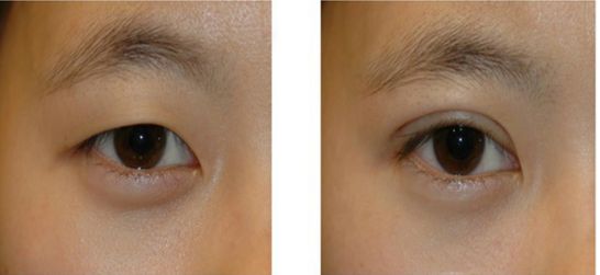 消除眼袋的方法：激光去眼袋的優(yōu)勢分析