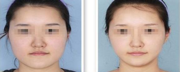 2020年雙眼皮手術(shù)費(fèi)用一覽表，雙眼皮整形手術(shù)價(jià)格查詢