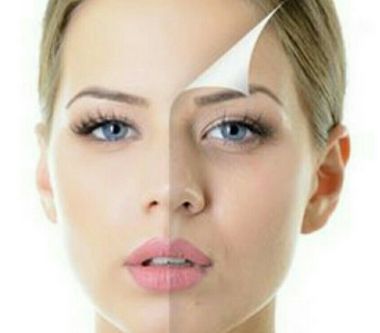 激光祛黃褐斑，美容增形象！潔凈面容的魅力無(wú)限！