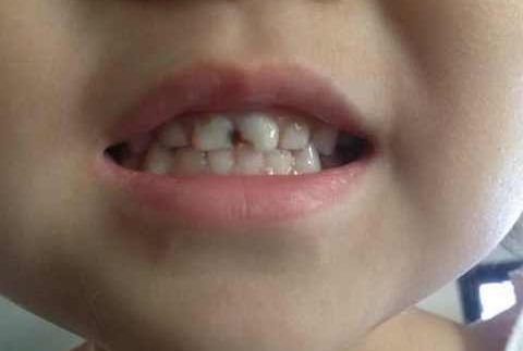 武漢洗牙費(fèi)用查詢，省錢有效的洗牙方案分享