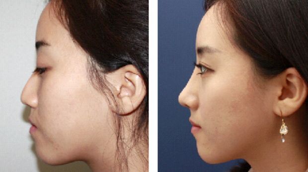 年齡段各異！北京眼袋手術(shù)，挑戰(zhàn)全年齡層！