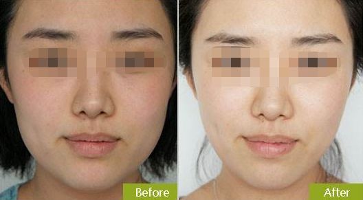 擁有光滑年輕肌膚，無(wú)需手術(shù)的神奇彩光嫩膚方法