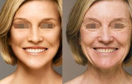 雙眼皮修復手術成果展示，煥發(fā)雙眸魅力