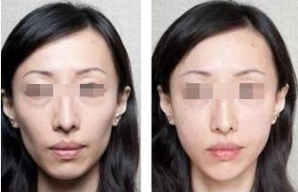 解決鼻炎問題的安全鼻整形方式