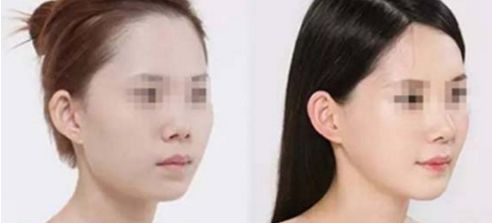 假體隆鼻手術(shù)帶來(lái)正自然效果，狀似真實(shí)鼻形