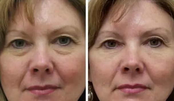 杭州昕微彩光嫩膚的操作步驟和效果如何