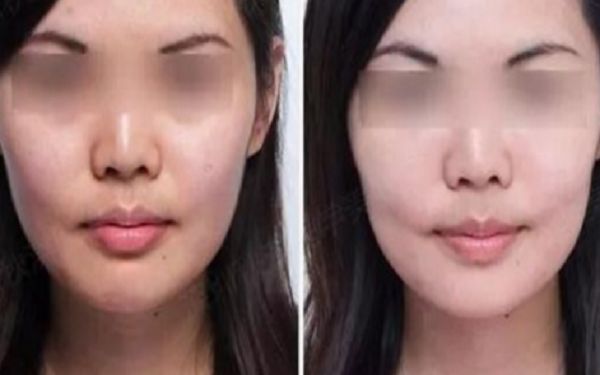 35歲采用超聲療程好還是熱瑪吉更好？匿名評測揭秘！