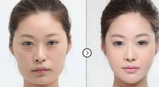 皮膚松弛，如何選擇適合的醫(yī)美項(xiàng)目？熱門方式如熱瑪吉、拉皮等對(duì)比解析！