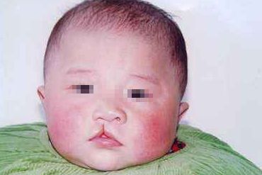 處女膜修復(fù)術(shù)后多久能恢復(fù)正常？