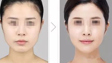 腿部纖體：有關(guān)吸脂手術(shù)的價(jià)格和效果分析