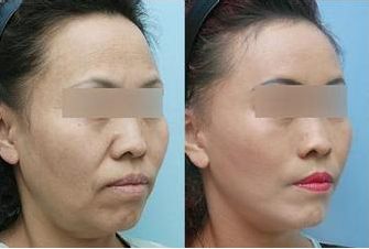 施爾美腹部抽脂：手術(shù)后保持效果長久嗎？