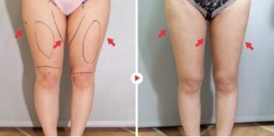 高效祛除眼袋的有效修復(fù)方法