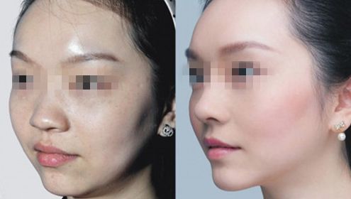 頜角磨骨整形手術(shù)及適應者的詳細解析