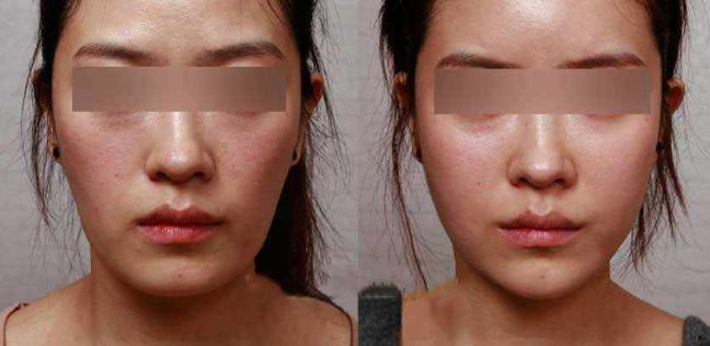 眼袋手術(shù)后效果持續(xù)多久？解析專家分享