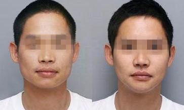 鼻部整形在哪個季節(jié)效果更佳